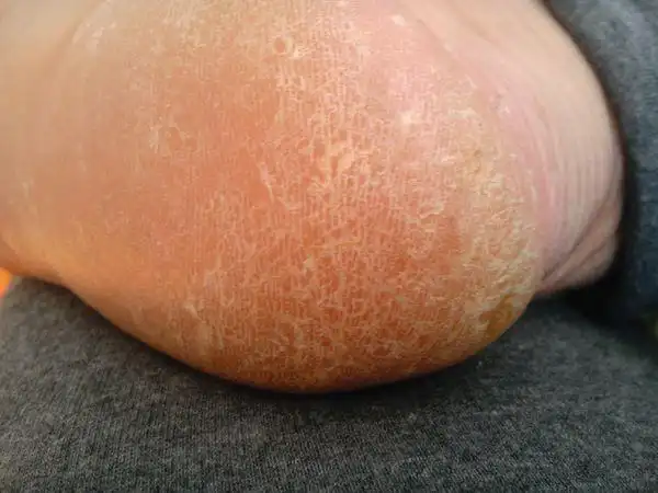 我脚底脱皮,有5到6年历史了,不知是不是脚气,怎么去治疗?非常感谢大家