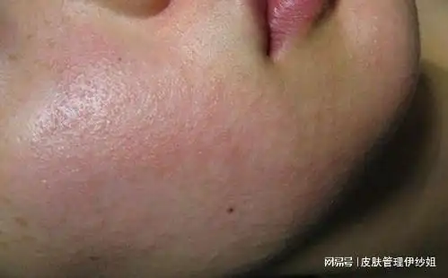 loica法式精油护肤臻品_用护肤造口粉治疗过敏水泡_对护肤品过敏该