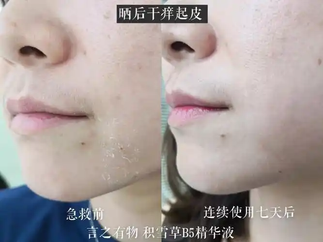 干燥,泛红,敏感……多是自己把皮肤作坏的