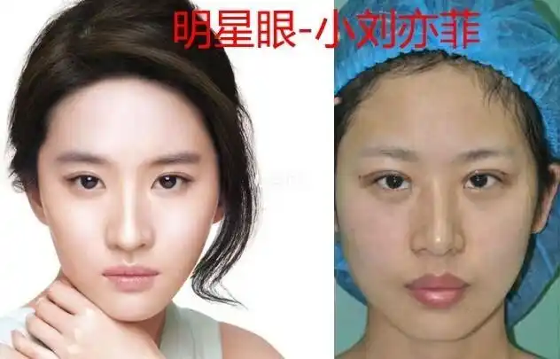 姑娘是刘亦菲模仿秀,卸妆后完全不像,所以来寻求手术帮助.