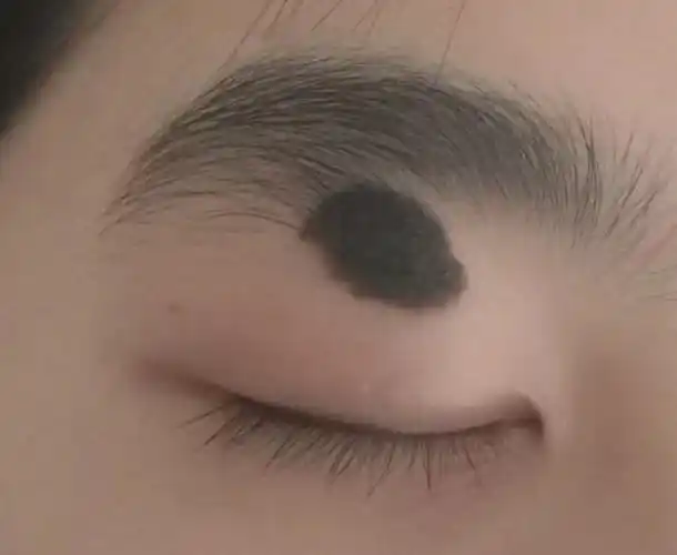 眼睑黑痣为什么切除后要首先选择直接缝合_痣_症状表现_治疗方式 - 好