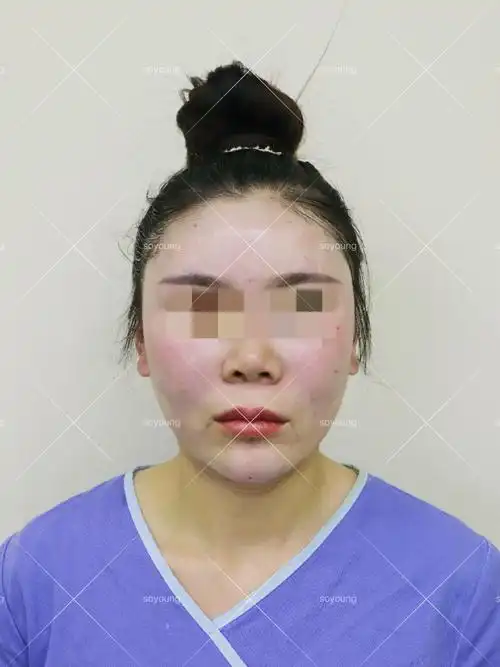 【北京清木自体脂肪填充面部】术后第七天