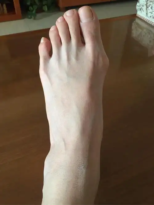 女生脚趾拇外翻是什么样体验? - 知乎