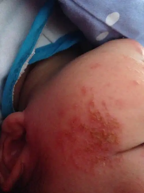 心疼死妈妈了,有宝妈知道怎么办吗?医院说是毛囊炎!求好办法!