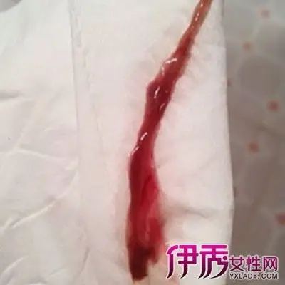 揭秘排卵期出血症状和治疗方法