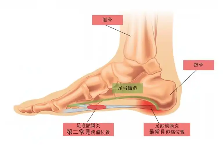 那些年捱过的足底筋膜炎 - 知乎