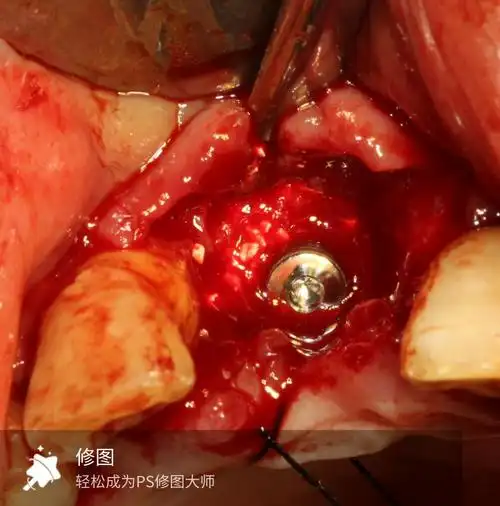 中切牙植骨种植修复