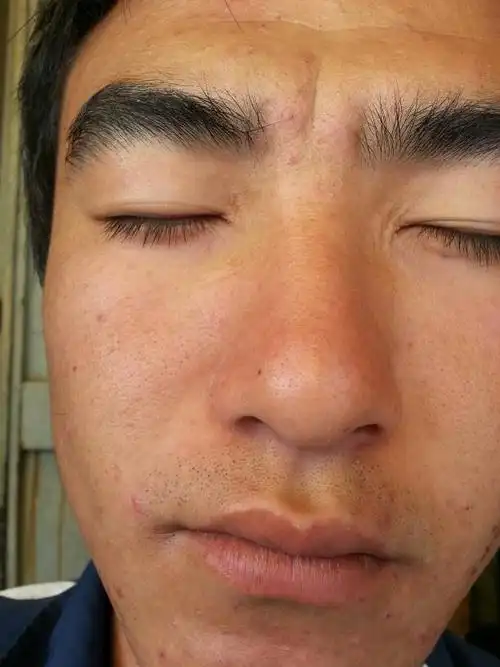 还有黄色的东西 青春期的时候总是挤痘痘 现在脸部毛孔粗大 还有痘印