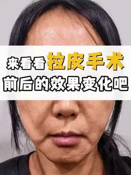 来看看拉皮手术前后变化吧