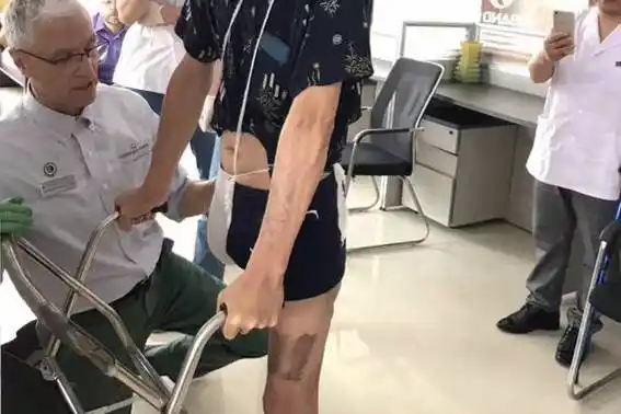 患者一般在做完截肢手术后,由于术中出血,术后淋巴,静脉回流障碍常