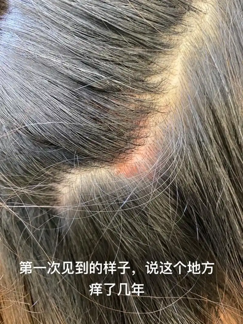 头癣.耳朵后面的头皮痒了三四年,每天半夜会痒醒,要用长指甲使 - 抖音