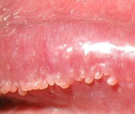 在阴茎的冠状沟处环绕龟头出现的淡红色小丘疹.