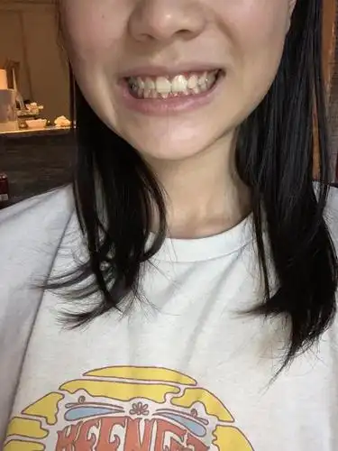 有没有人是整牙之后变成咬合不正深覆合的