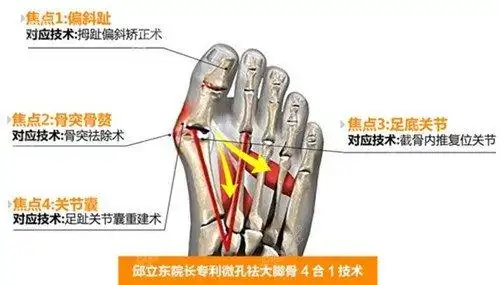 项目一:大脚骨手术 大家都知道关于大脚骨手术,有好多医院是做不了的.