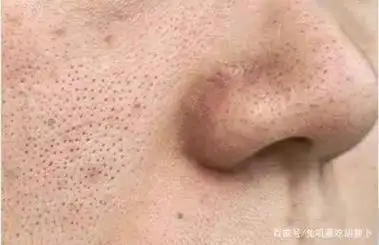 鼻子上毛孔粗大怎么办?快来看看你是哪种毛孔问题
