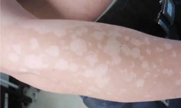 阜阳皮肤病医院治疗前胸后背出现的白色斑块汗斑怎么样