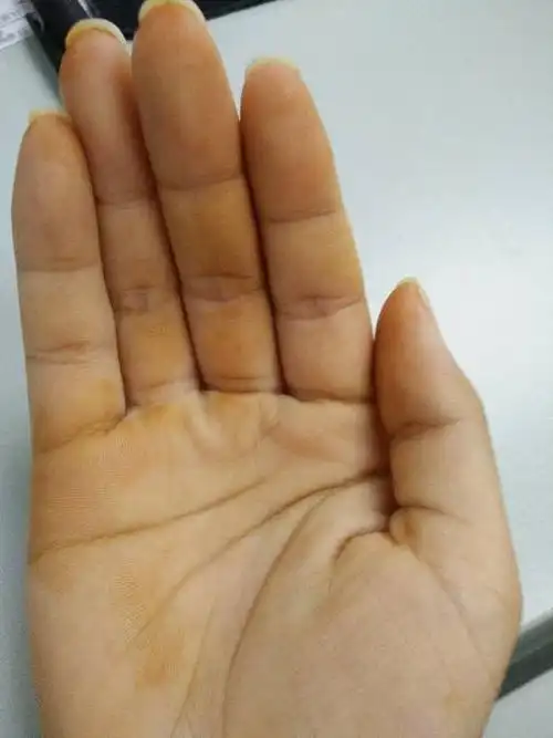 手突然变黄怎么回事?求解答