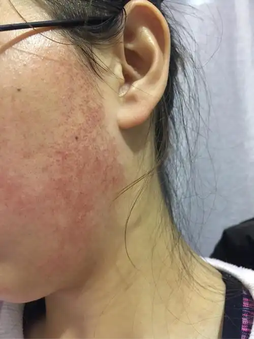 脸颊发红是什么原因,常年都有,求各位帮忙看一下?