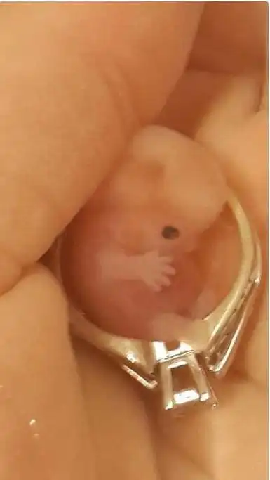 这位母亲对他们的爱是永恒的这个是这位目前在7周半就停止生长的宝宝