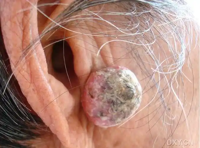 【原创】术前活检很重要(耳前肿物) - 耳鼻咽喉头颈外科 -丁香园论坛