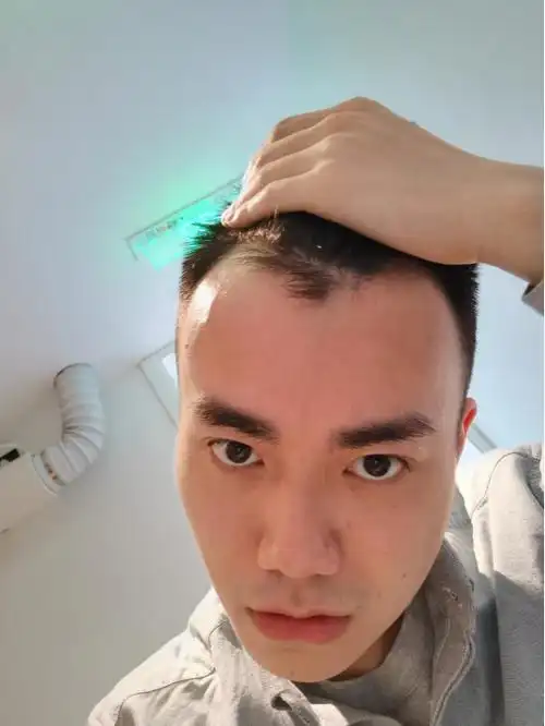 李先生植发主要为了改善额角,m型消失,发际线更贴合外形气质!