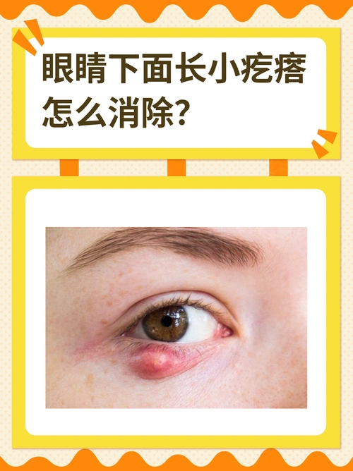 眼睛下面长小疙瘩,怎么消除