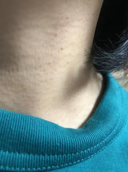 网友  2019-09-01   展开全部 看了你的图片,我感觉有点儿像扁平疣