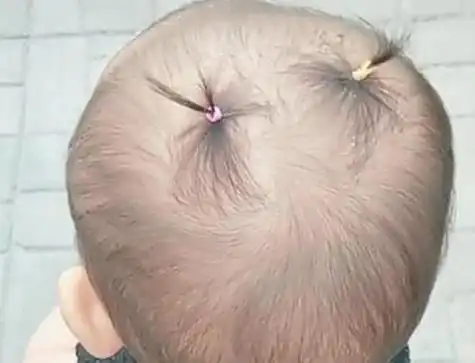 新生婴儿头发稀疏几年后发量却逆袭是因为胎毛剃得早吗