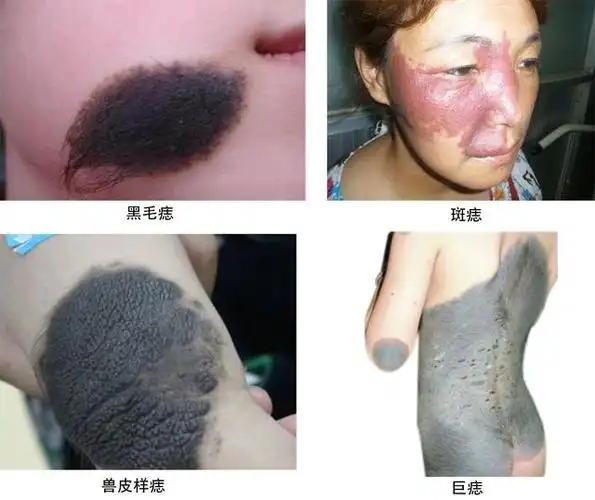 黑毛痣难治吗?治疗黑毛痣需要几次?