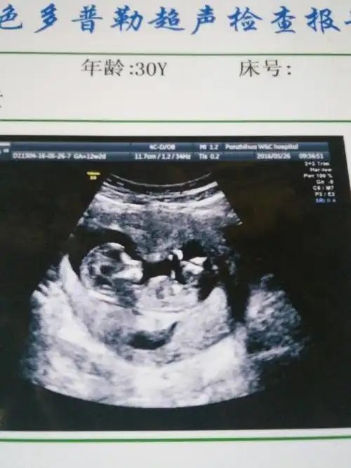 12周nt能看出男女嘛