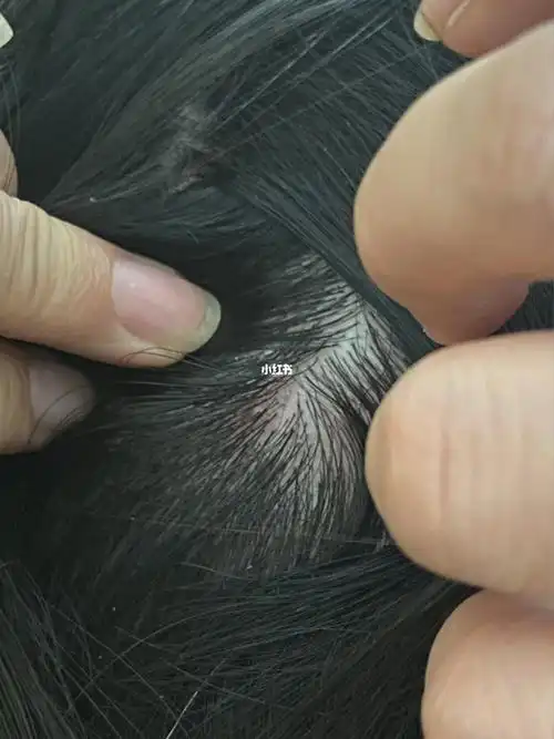 头上满满的红疙瘩,很痒,怎么办?