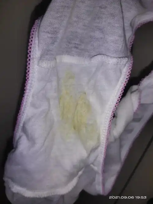 细菌性阴道炎停药两天就会复发(内有白带图片)