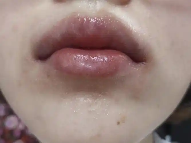 芒果过敏的朋友不要喝杨枝甘露啦!_杨枝甘露_过敏_生活记录_日常片段