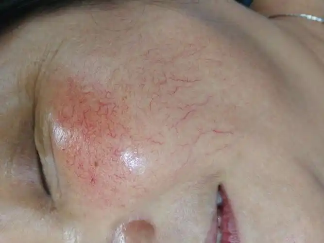 用药不当所致的红血丝