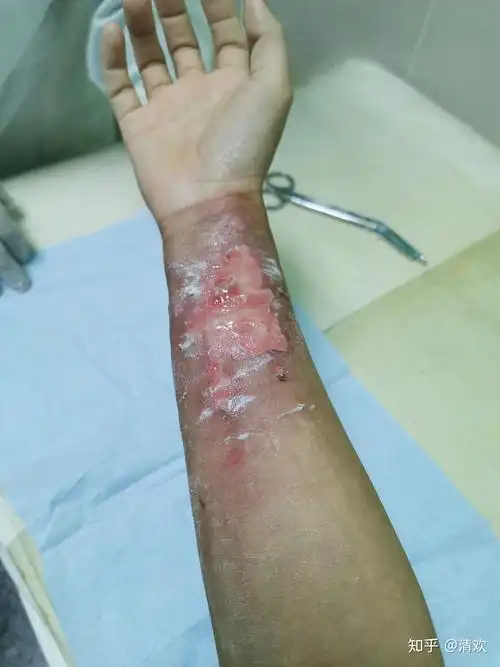 手臂烫伤到痊愈的全记录 - 知乎