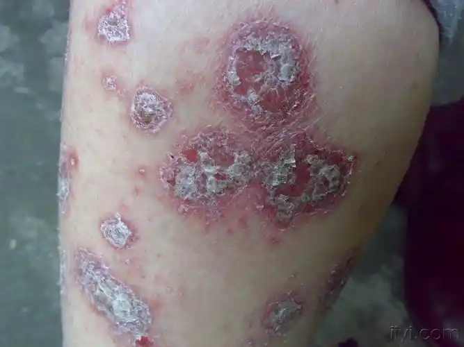 [皮肤病] 经典图片 银屑病