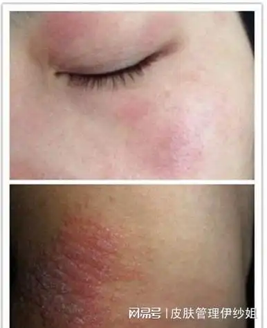 揭秘化妆品过敏的真相