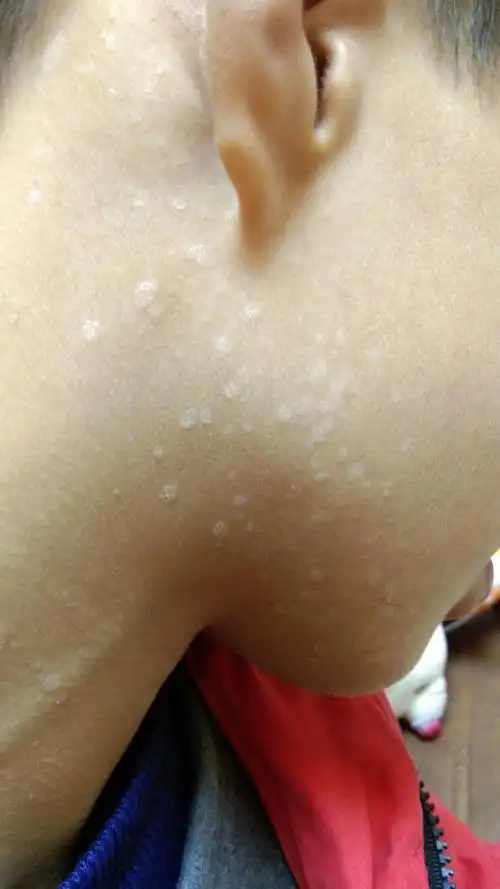 一挠哗哗得掉皮,常见有褐色,白色(脖子白色汗斑居多)等成片的圆形斑点