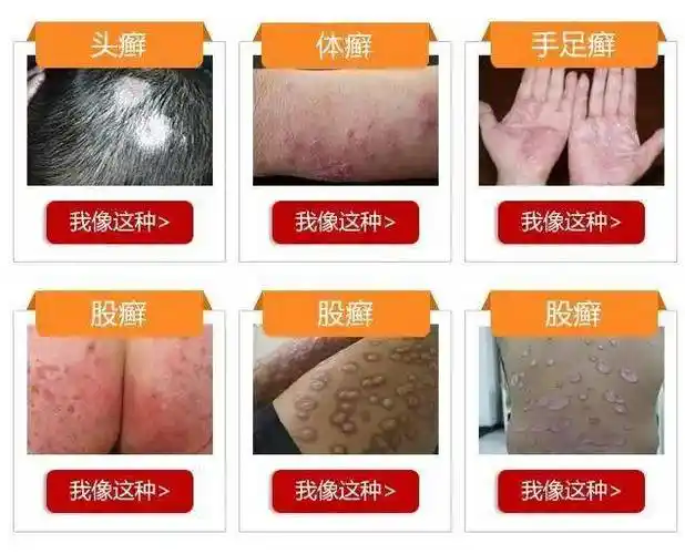 重点|皮肤癣的辨别,治疗与预防归纳总结