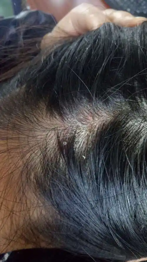 头部长了很多皮屑一样的东西请问是什么不痛不痒