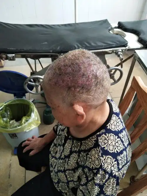 头皮多发性化脓性毛囊炎病例一例