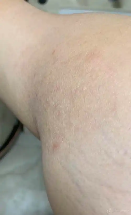 全身皮肤散在复发慢性皮肤干燥伴丘疹