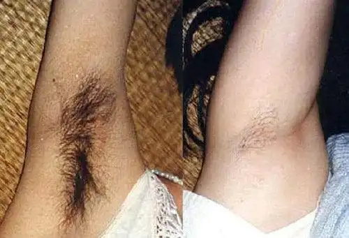 夏天来了可以穿上漂亮的裙子,展现那娇好的身段,可腋下那浓密的腋毛确