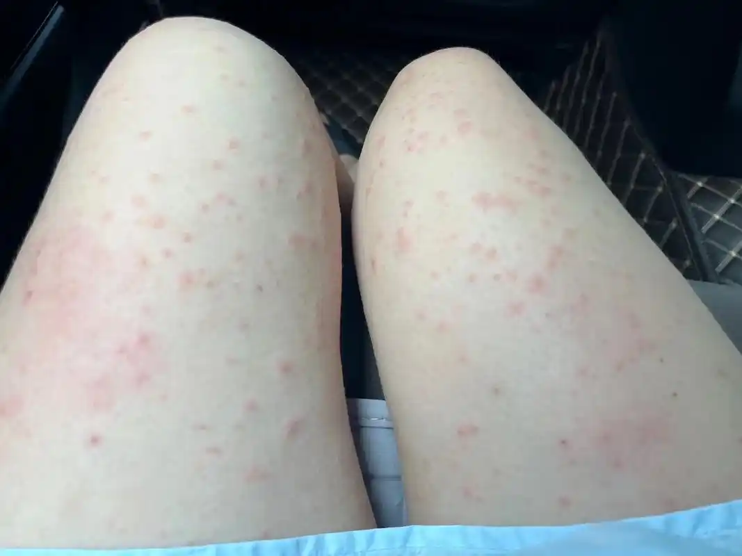 孕晚期湿疹真要命.#孕晚期日常 #熬过了就好了 距离预产期还 - 抖音