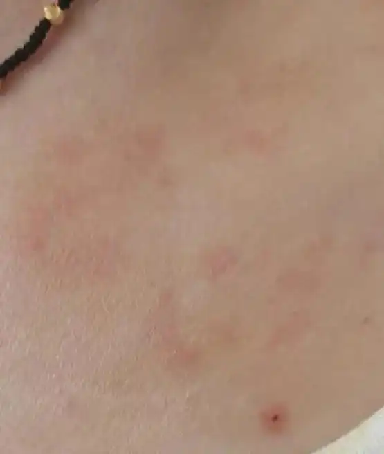 过敏性皮炎乔峰