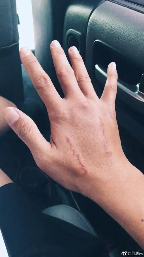何润东晒x光照,手上骨头都断了还健身,网友:太心酸了!