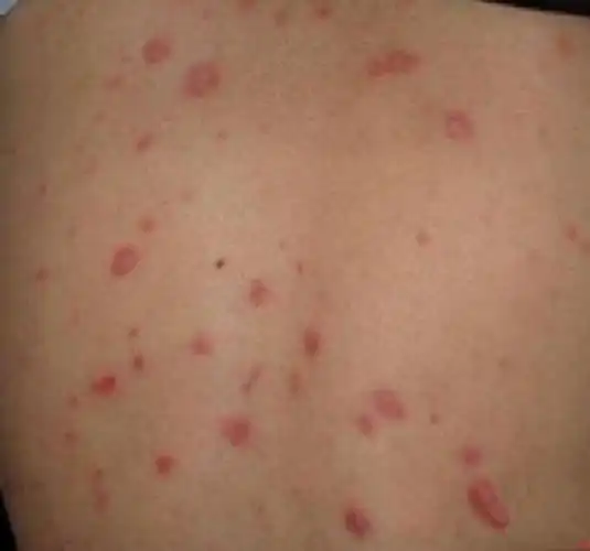 一期梅毒图片——肛门部硬下疳图片_有来医生