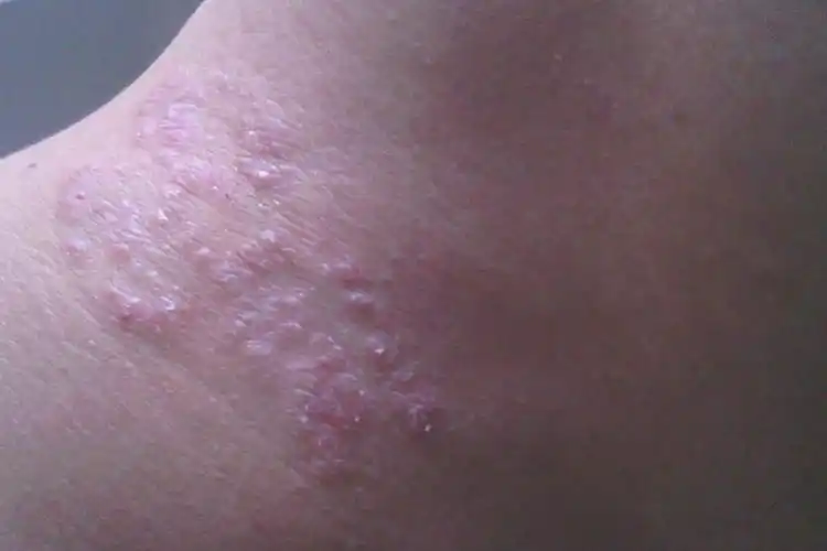 高大!湿疹图片初期症状图"不堪盈手赠"-第2张图片-酷虎博客