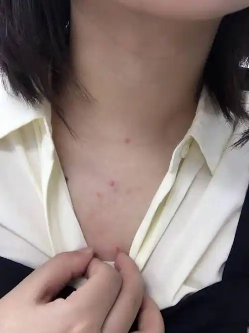 胸背部长痘痘怎么办?和面部长痘护理完全不同思路_皮肤_毛囊_硫磺