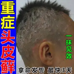 头皮癣药膏真菌感染治顽固头皮藓头部头癣银屑癣毛襄囊炎疙瘩特效
